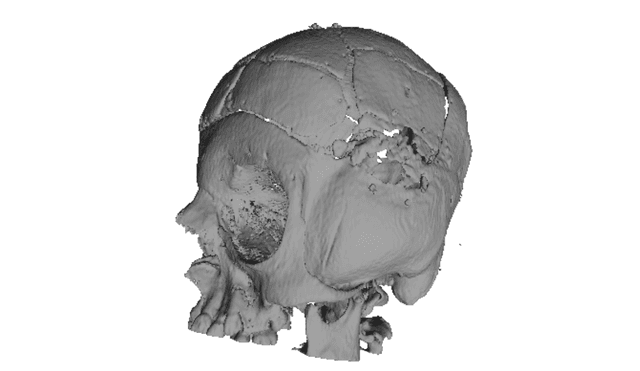 Thumbnail of Open Cranioplasty Im G2