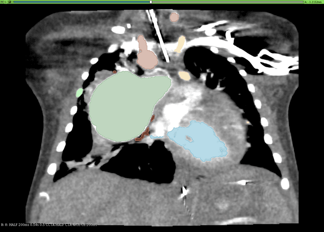 Thumbnail of 11 Tetralogy of Fallot Scene