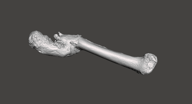 Femur Fracture