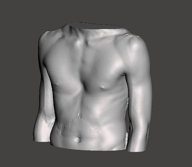 Pectus Excavatum