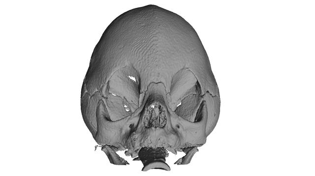 Thumbnail of Craniostenosis Syndrom After Posterior Vault Decompression 1