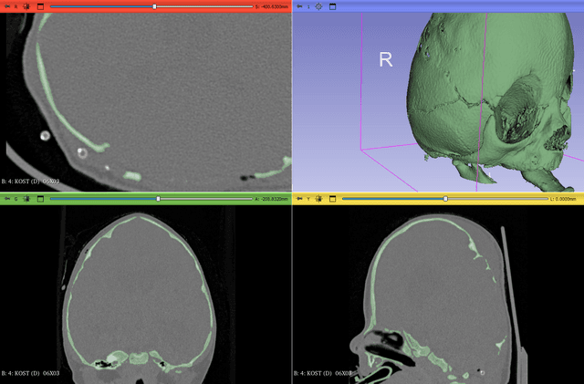 Syndromal Craniosteosis – Crouson Syndrome – After Posterior Vault Decompression