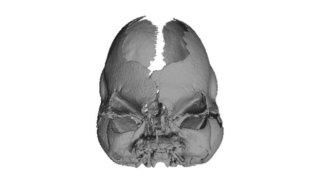 Thumbnail of Apert Syndrome Im G1