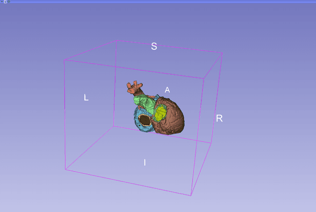 Thumbnail of 15 Transposition of Great Arteries Scene