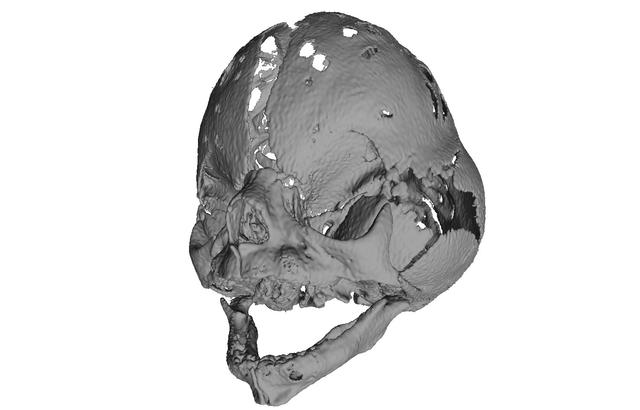 Syndromal Craniosteosis – Crouson Syndrome