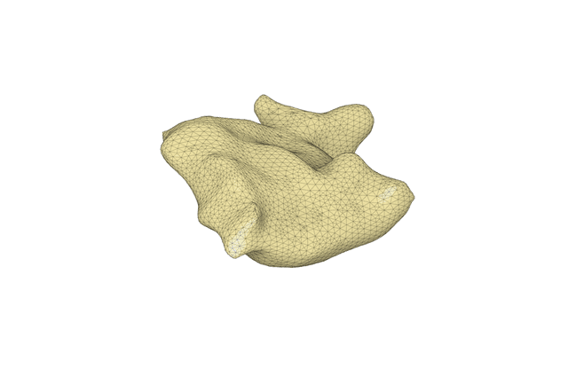 Thumbnail of Subaortic Membrane