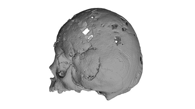 Thumbnail of Craniostenosis Syndrom Frontal Orbital Advancement 2