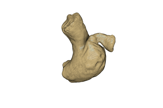 Thumbnail of Arteria Pulmonalis