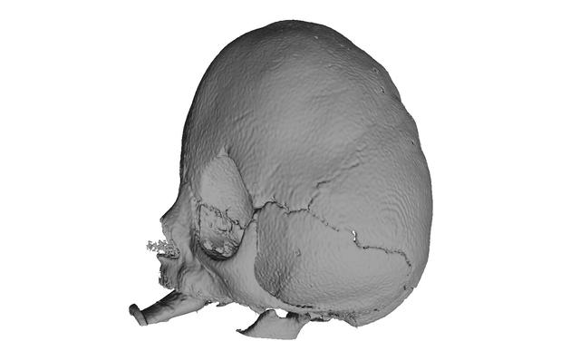 Thumbnail of Craniostenosis Syndrom After Posterior Vault Decompression 2