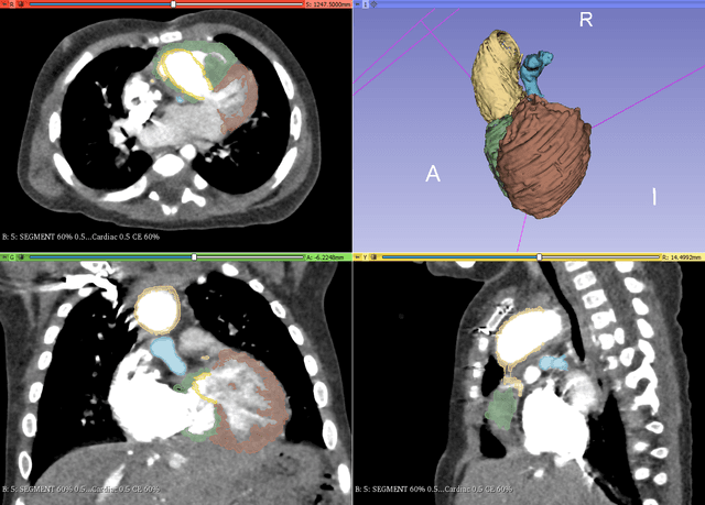 Thumbnail of 6 Rare Congenital Heart Defect