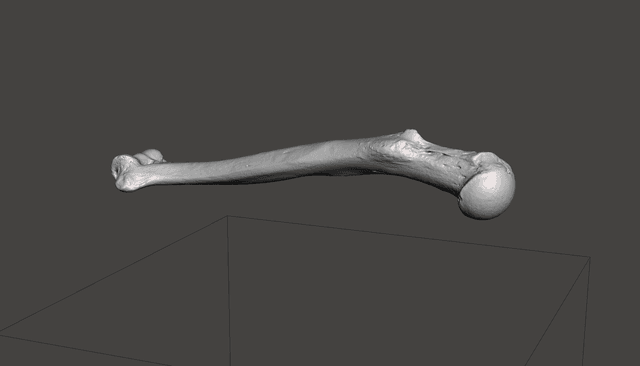 Humerus Poorly Treated Fracture