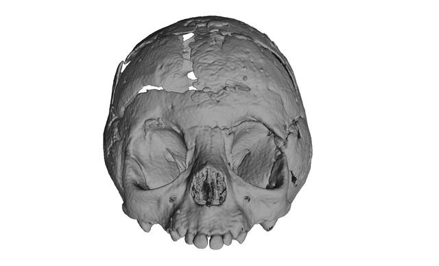 Craniostenosis Syndrom