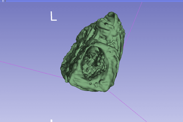 Small Ventricular Septal Defect (mVSD)