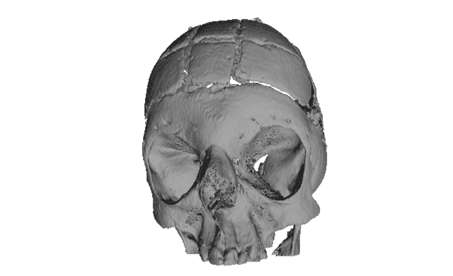 Open Cranioplasty – Bone Reposition