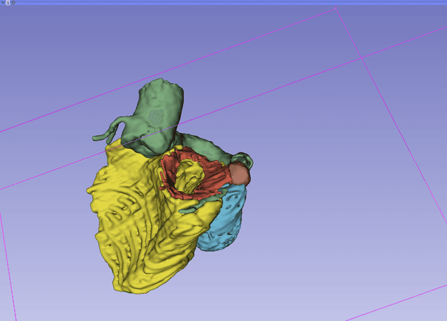 Thumbnail of 12 Coronary Artery Fistula