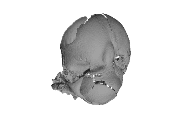 Thumbnail of Apert Syndrome Im G2